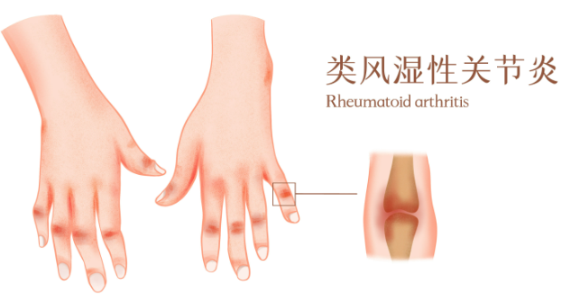 邵陽創(chuàng)傷骨科,邵陽風濕病區(qū),邵陽骨質增生,邵陽關節(jié)病區(qū),邵陽頸椎病區(qū)